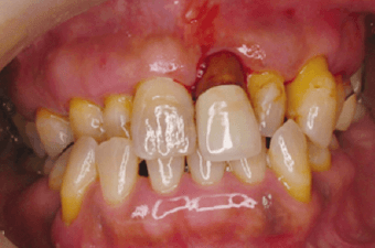 歯周病の歯のイメージ