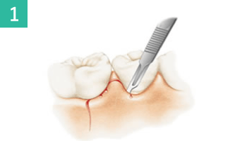 歯周外科手術による歯肉弁の作成のイメージ