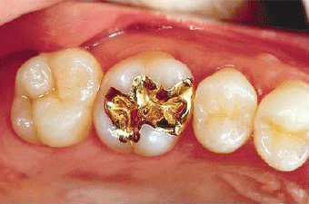 軽度のむし歯：C1、中度のむし歯：C2の治療例