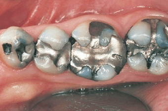 保険（銀歯）：金属疲労と経年的劣化の不適合
