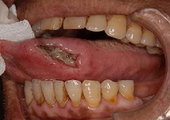 潰瘍型の舌癌