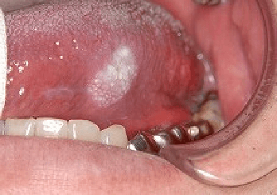 白い“できもの”ができた舌癌