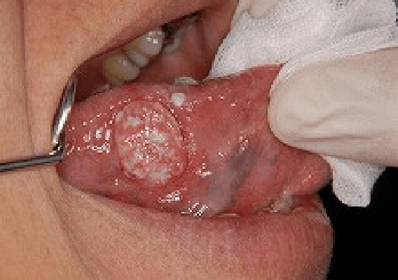隆起した症例の舌癌