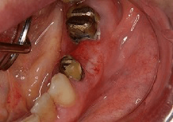 赤くただれた歯肉癌