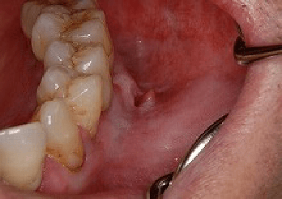 潰瘍タイプの歯肉癌