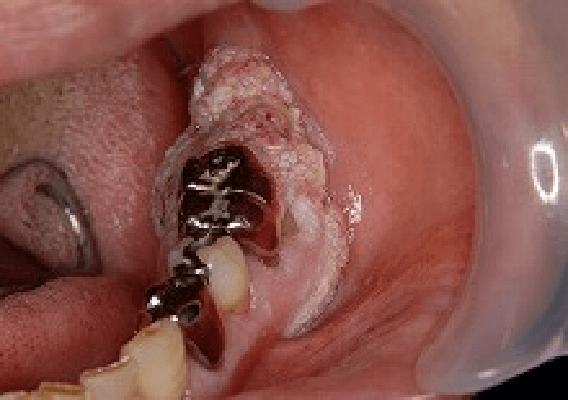 隆起した症例の歯肉癌