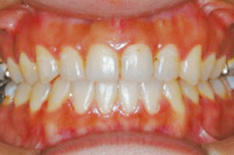 非抜歯矯正の事例