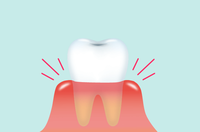 親知らず周辺の歯茎は、体調により炎症を起こす方が多いです