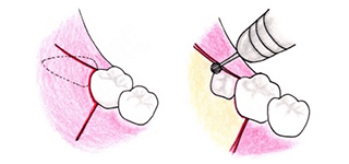 切開によって歯肉を開いて、智歯と骨が見えるようにします。