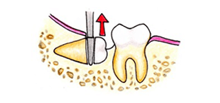 歯冠と歯根をタービンにより分割し、歯冠の部分を取り出します。